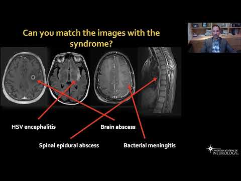 Virtual Resident Education Lecture Series: Neuroinfectious Diseases - American Academy of Neurology