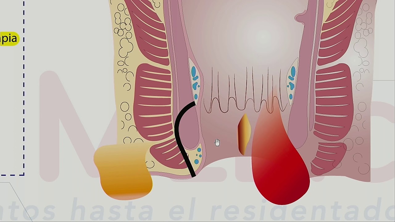 Cirugía General - Patología anorrectal - Dr. William Guzman