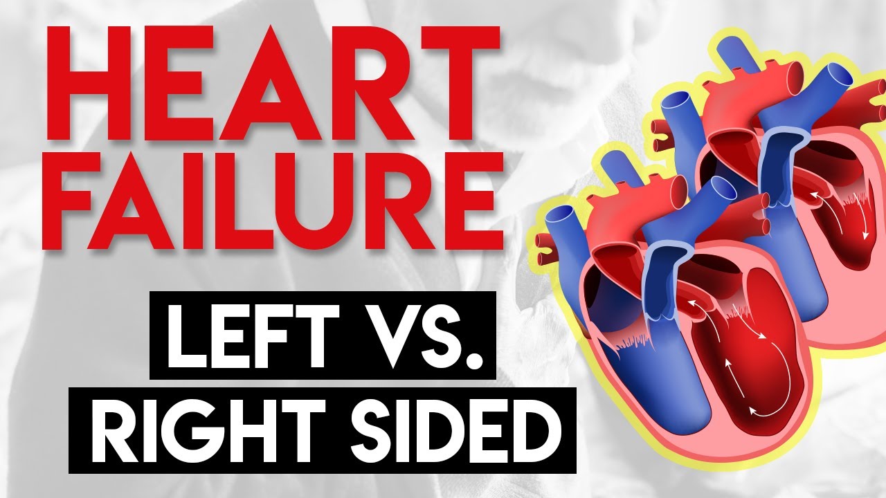 Does PDA cause left or right heart failure? Tipseri