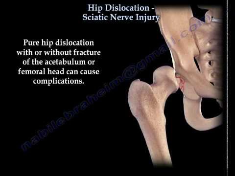 Hip Dislocation , Sciatic Nerve Injury - Everything You Need To Know - Dr. Nabil Ebraheim