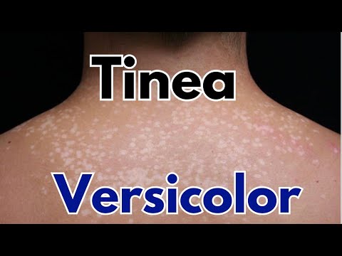 Tinea versicolor symptoms treatment | how to get rid of tinea versicolor