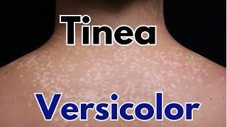 Tinea versicolor symptoms treatment | how to get rid of tinea versicolor