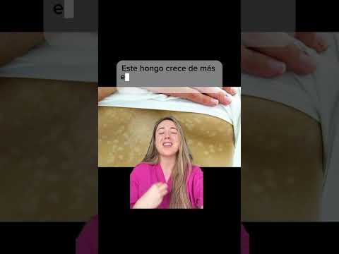 Dermatologist explains white spots on the skin #dermatologist #skincaretips #skinspots