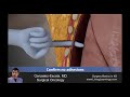 Chest Tube Animation