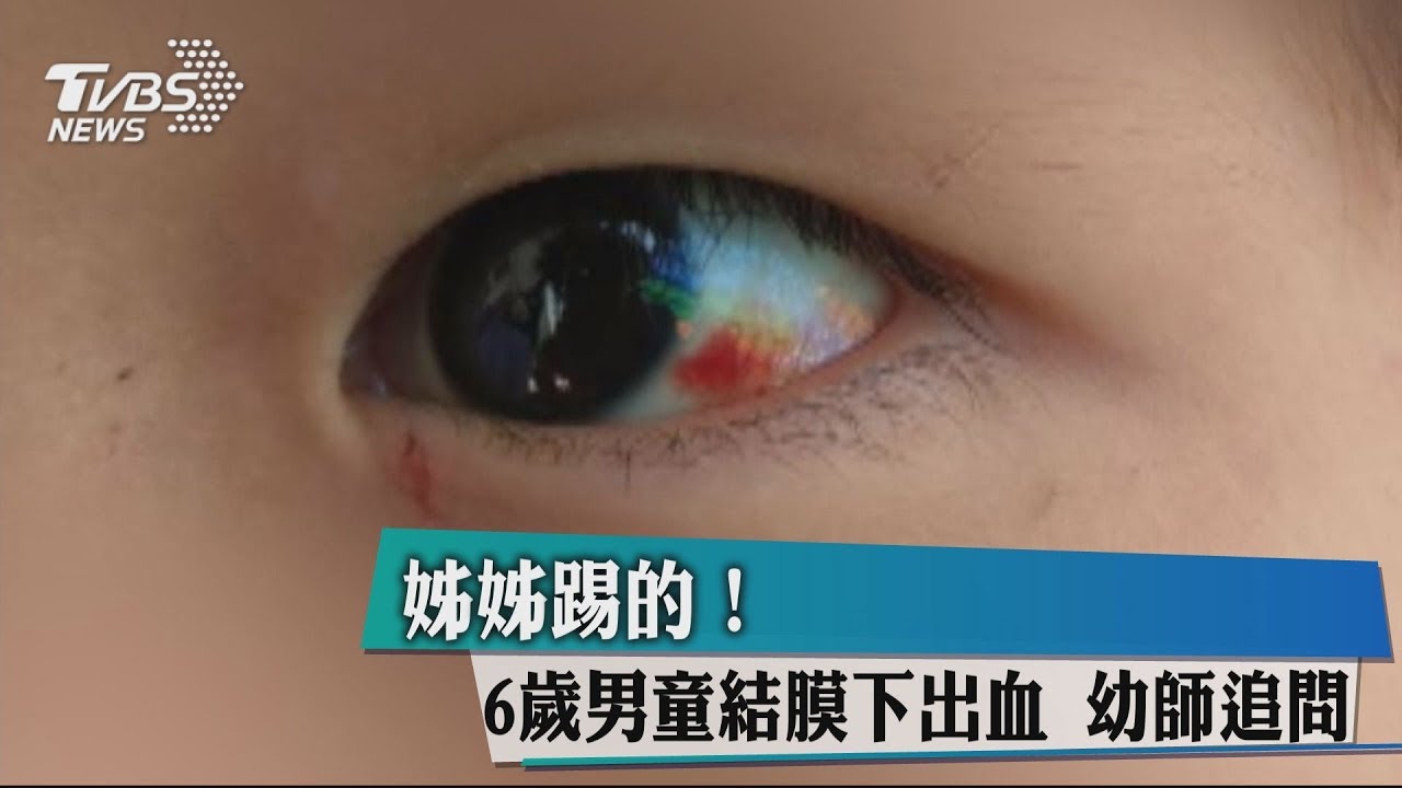 姊姊踢的!6歲男童結膜下出血 幼師追問