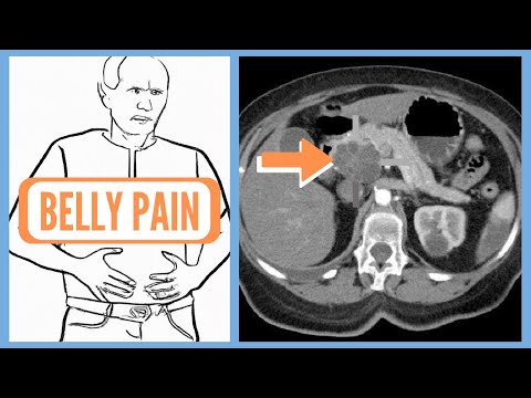 Warning Signs of Pancreatic Cancer