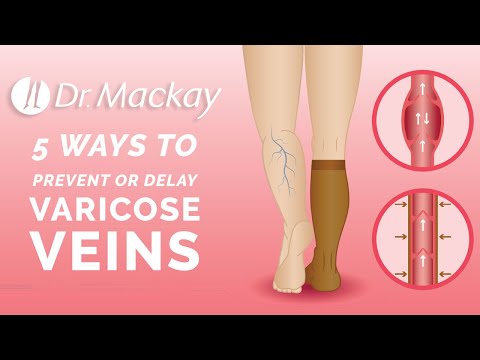 How to Prevent Varicose Veins by Dr. Edward Mackay