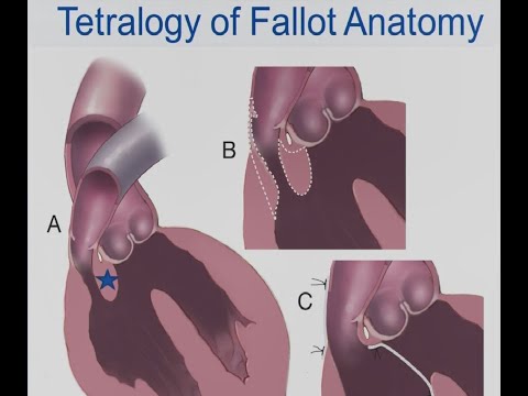 Mayo Clinic – Tetralogy of Fallot