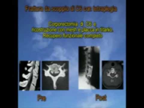 LFK borsite del gomito Ipertono del rachide cervicale in un bambino