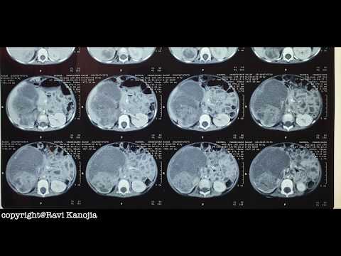 Wilms Tumor mit Tumorthrombus in der Vena cava inferior