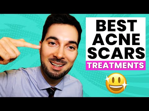 How To Get Rid Of Stretch Marks Removal and Treatment