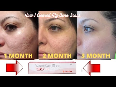 Tarzet tazarotene 0.1 cream, for personal, packaging size: 2...