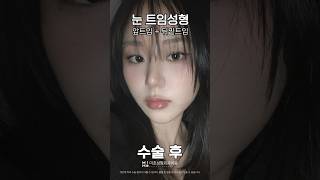 앞트임 성형 시술