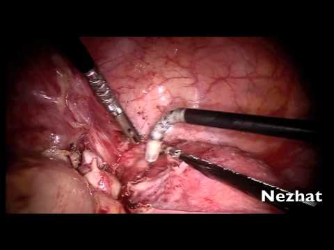 Laparoskopische Chirurgie beim Uterus unicornis