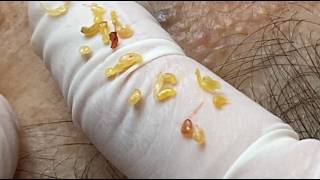 Get ROCK ACNE for lady (P.14) #HoangMySpa195