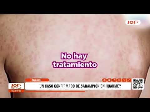 Áncash: Un caso confirmado de sarampión en Huarmey