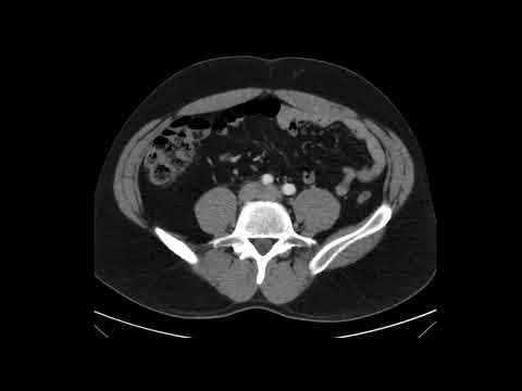 Massive Traumatic Retroperitoneal Hematoma, CT Unannotated