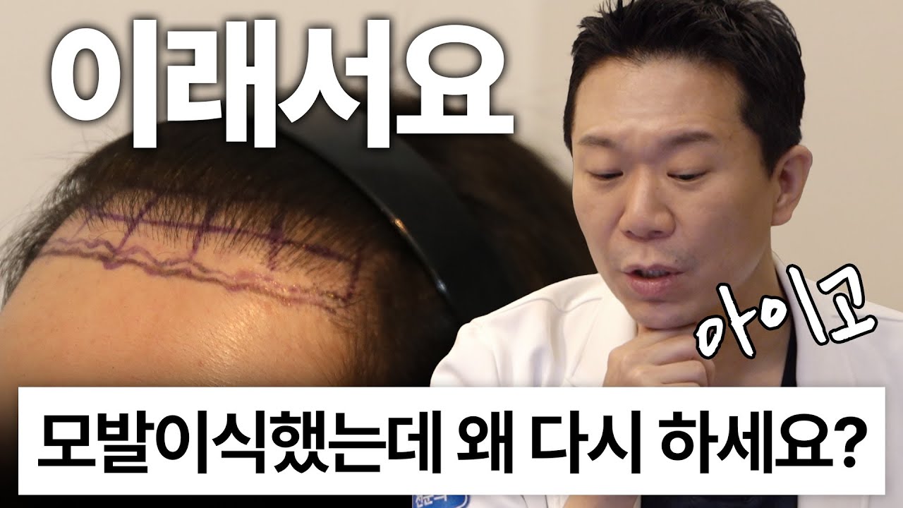 모발이식도 실패할 수 있나요? (재수술 애프터 공개)