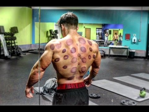 Insane Chinese Cupping experience, With the Aftermath!