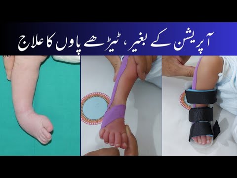 Club foot physiotherapy treatment | Exercises,Taping,Splint ٹیڑھے پاوں کا علاج #stretching #physio