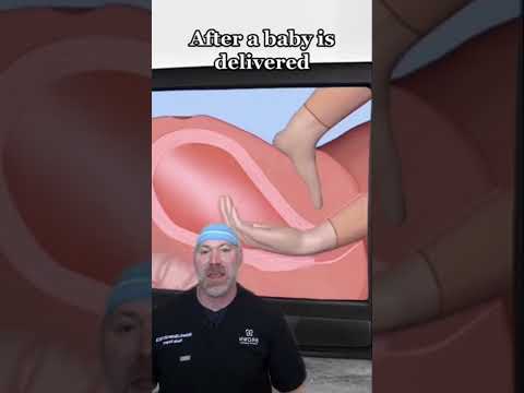 Removing a Placenta by Hand?! 😱 #shorts