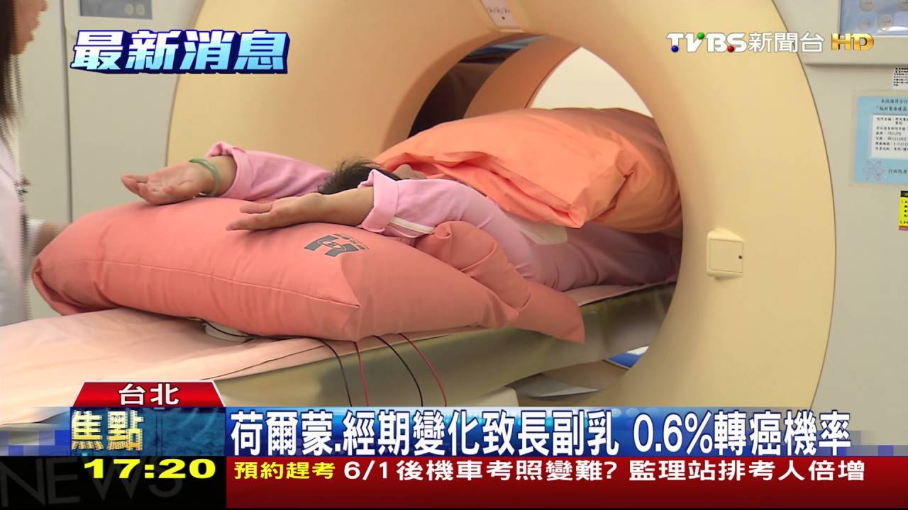 全球唯二!臀長副乳 基因突變誤為脂肪瘤