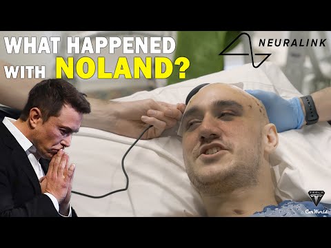 It Happened! BIG Trouble Happened with First Human Trial Neuralink Chip N1! HARSHER Than You Think!