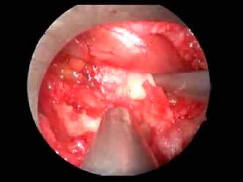 L5-S1 Disc Removal Using Endoscopic Method Due Ton Non-Contained Hernia