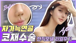 자가늑연골 코재수술 솔직후기 2탄