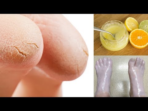 Tutti sono diventati coperti da psoriasi Che psoriasi curata zavorotnyuk