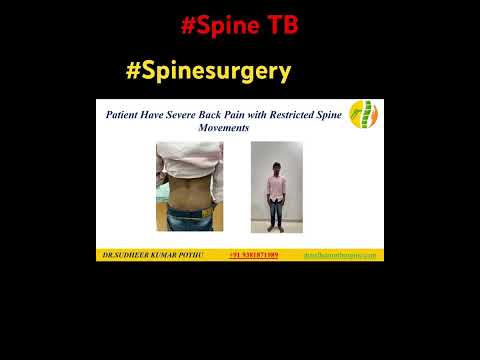 Spine Tuberculosis successfully treated