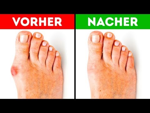 5 effektive Wege, Fußballen-Schmerzen zu lindern