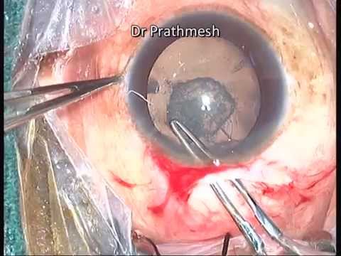 What To Do When- Steps To Manage Complication During Manual SICS Surgery By Dr Prathmesh Mehta 