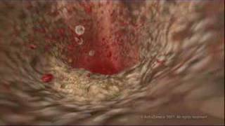 MEDICAL - How cholesterol clogs your arteries (atherosclerosis)