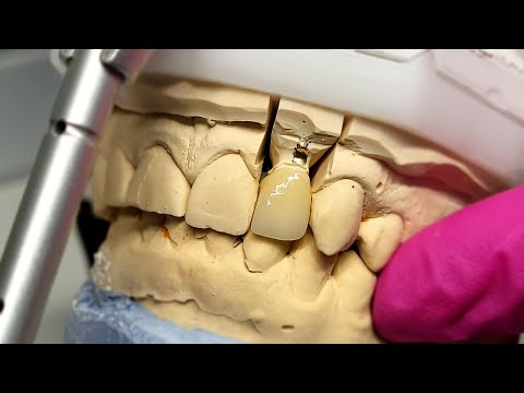 ASMR Glaze and Stain / Zirconia / Full Contur Crown