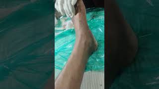 Dressing of my diabetic toe by a professional nurse at home