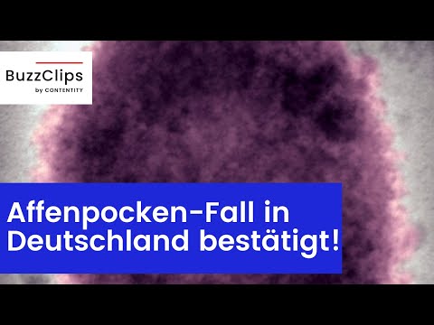Erster Fall von Affenpocken in Deutschland bestätigt!