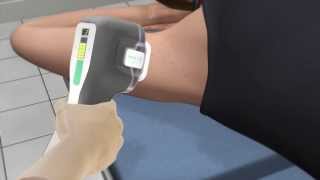 Miradry - Permanent Solution to Excessive Underarm Sweating (Hyperhidrosis)