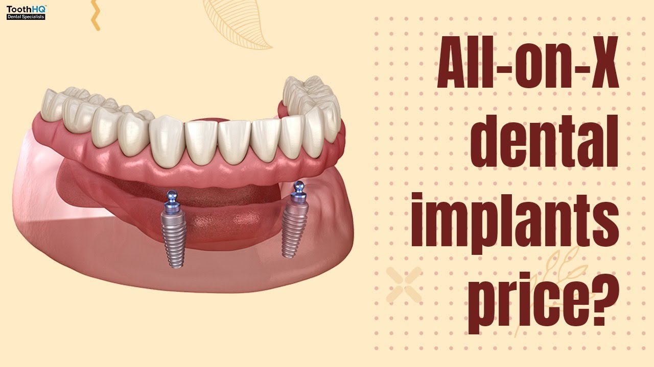 Are All-on-X implants a permanent solution?