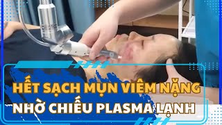 PLASMAMED: ĐIỀU TRỊ MỤN VIÊM NẶNG HIỆU QUẢ CHỈ SAU 1 LIỆU TRÌNH