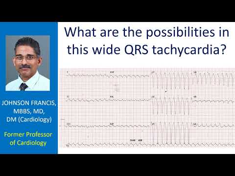 What are the possibilities in this wide QRS tachycardia?