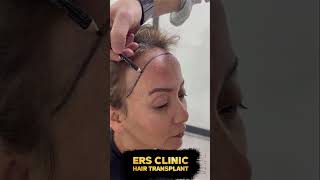 Kadınlarda Saç Ekimi İşlemi Ers Clinic Şişli İstanbul  #sacekimi #hair