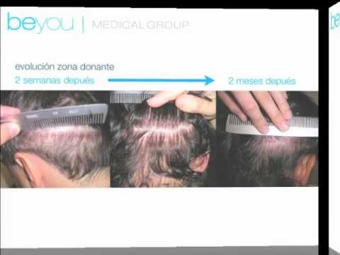 Resultados de Injerto Capilar en Beyou Medical Gruoup