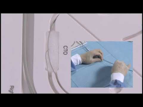 Angioplasty technique: a retrograde approach for CTO (+English subtitle)