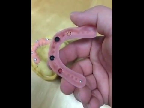 Prothese auf Implantaten und Locatoren  Locator / gaumenfreie Prothese / herausnehmbarer Zahnersatz