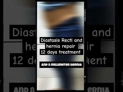 Diastasis Recti and hernia repair after 12 days: Arogya physiotips #diastasisrecti #hernia