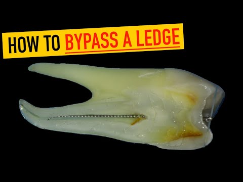 How to Fix a Ledge in Root Canal (Step-by-Step Technique)