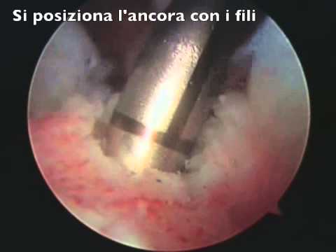 Esercitare in bicicletta nella malattia delle articolazioni Perché ferire le articolazioni delle mani e come trattarli