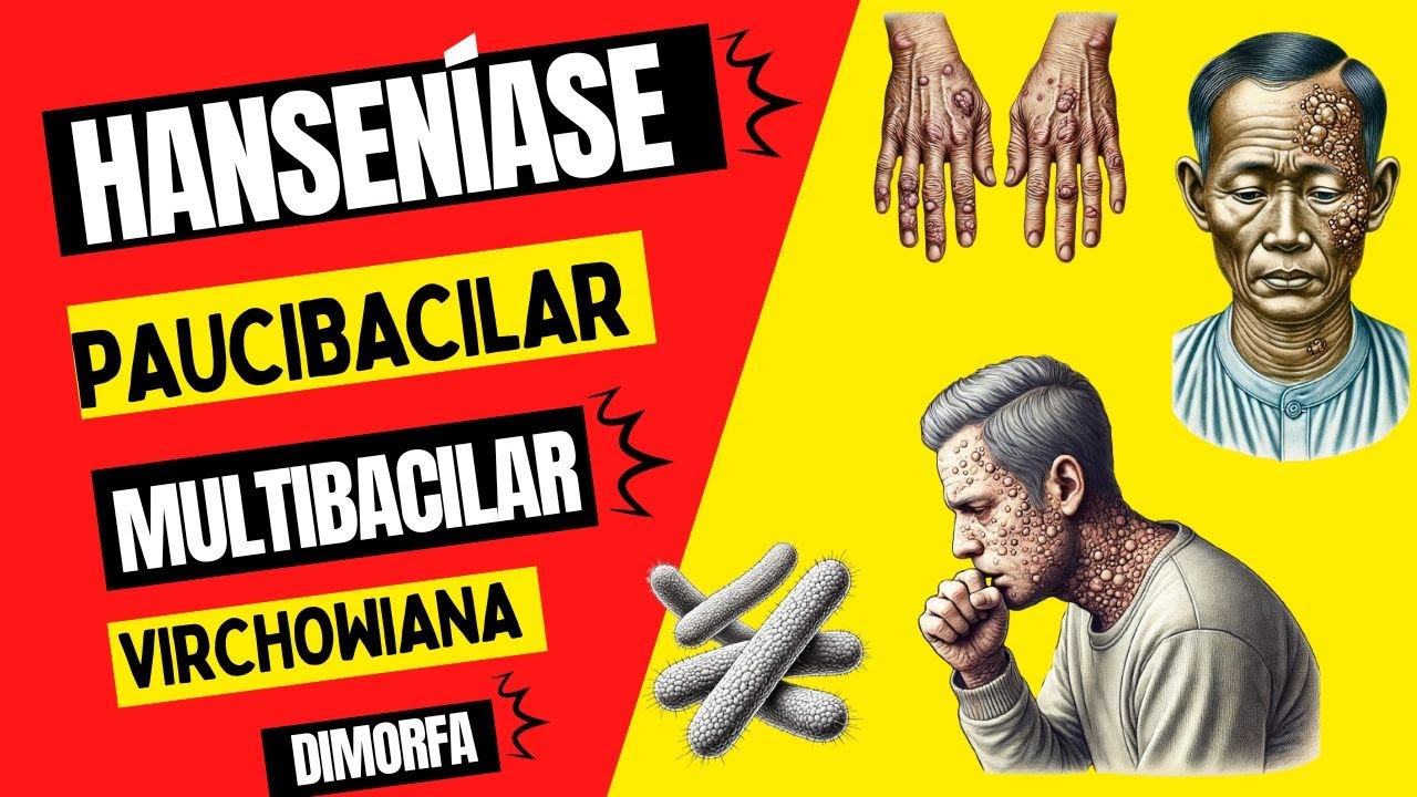 Tipos de Hanseníase - Hanseníase Paucibacilar e Multibacilar?  Virchowiana