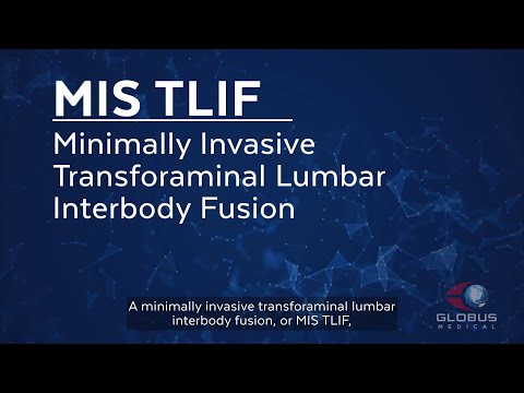 MIS TLIF - Patient Animation